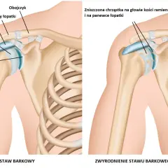 Zdrowy staw barkowy z szerokimi barkami po lewej, po prawej zwyrodnienie stawu z uszkodzoną chrząstką.