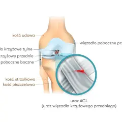Anatomia kolana z zaznaczonym zerwanym więzadłem krzyżowym przednim (ACL). Powiększenie pokazuje pęknięcie w strukturze więzadła.