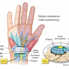 Anatomia dłoni i nadgarstka, pokazująca nerw pośrodkowy i ścięgna w kanale nadgarstka, obszar drętwienia i bólu.