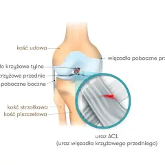 Anatomia kolana z zaznaczonymi więzadłami. Powiększenie pokazuje uszkodzenie więzadła krzyżowego przedniego (ACL).