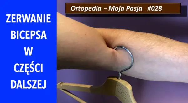 Zerwanie bicepsa w części dalszej. Ramię z wieszakiem, symbolizujące uraz. Ortopedia – Moja Pasja #028.