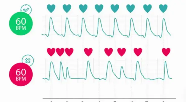 Dwa wykresy EKG, jeden z zielonym znacznikiem i 60 BPM, drugi z czerwonym i 60 BPM. Rytm serca jest regularny, ale w drugim przypadku tetno 100 wydaje się być nieregularne.