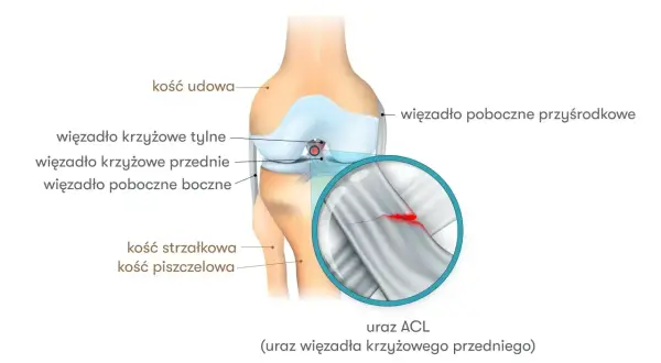 Anatomia kolana z zaznaczonym zerwanym więzadłem krzyżowym przednim (ACL). Powiększenie pokazuje pęknięcie w strukturze więzadła.