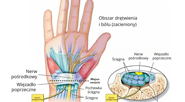 Anatomia dłoni i nadgarstka, pokazująca nerw pośrodkowy i ścięgna w kanale nadgarstka, obszar drętwienia i bólu.