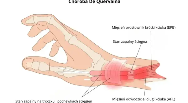 Ilustracja pokazuje zapalenie ścięgna nadgarstka w chorobie De Quervaina, z zaznaczonym stanem zapalnym na troczku i pochewkach ścięgien kciuka.