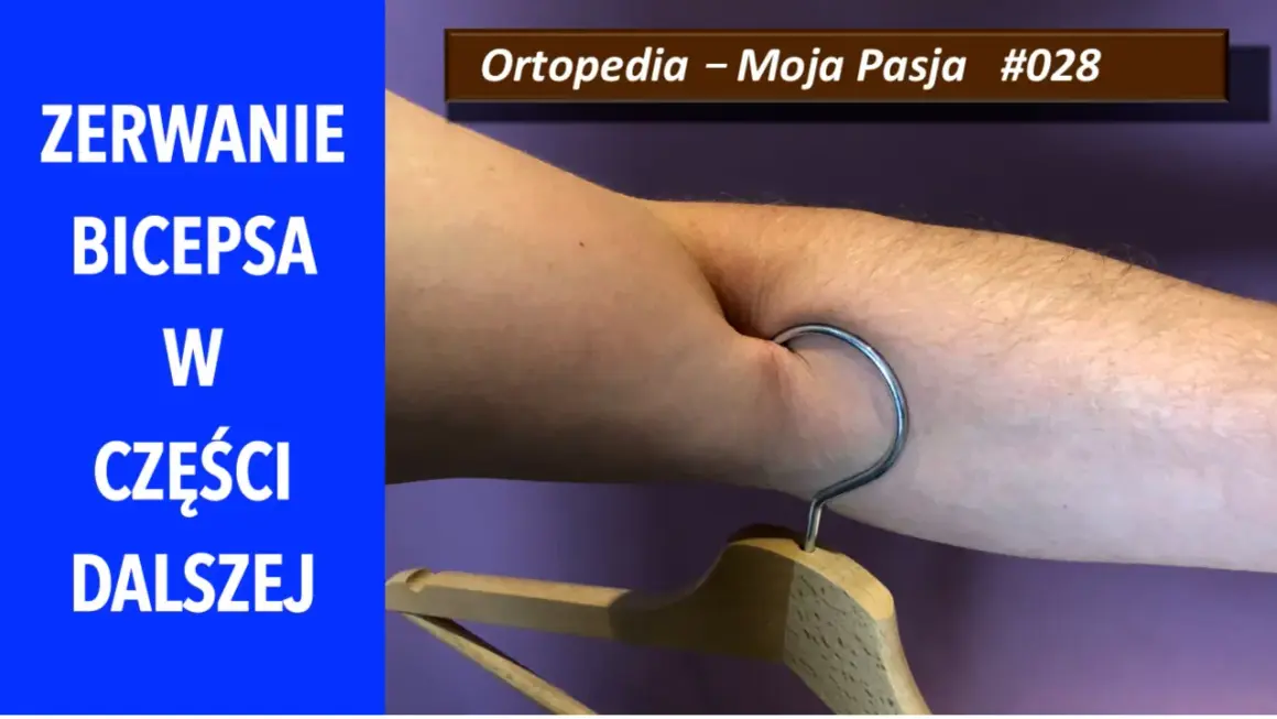 Zerwanie bicepsa w części dalszej. Ramię z wieszakiem, symbolizujące uraz. Ortopedia – Moja Pasja #028.