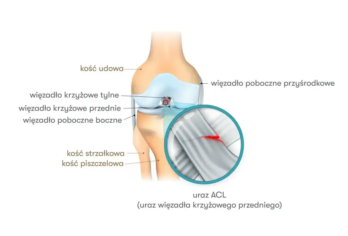 Anatomia kolana z zaznaczonymi więzadłami. Powiększenie pokazuje uszkodzenie więzadła krzyżowego przedniego (ACL).