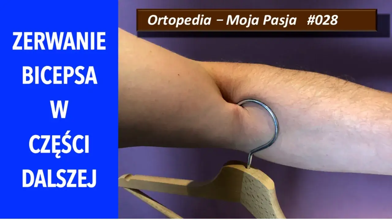 Zapalenie ścięgna bicepsa, widoczne jako zagłębienie na ramieniu, gdzie wisi wieszak.