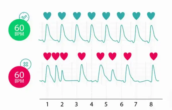 Dwa wykresy EKG, jeden z zielonym znacznikiem i 60 BPM, drugi z czerwonym i 60 BPM. Rytm serca jest regularny, ale w drugim przypadku tetno 100 wydaje się być nieregularne.