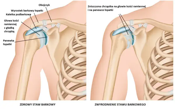 Zdrowy staw barkowy z szerokimi barkami po lewej, po prawej zwyrodnienie stawu z uszkodzoną chrząstką.