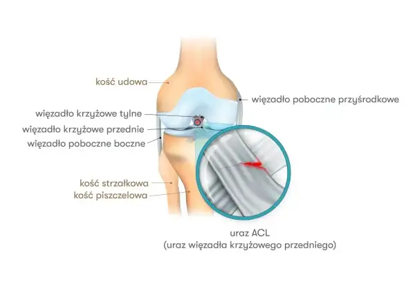Anatomia kolana z zaznaczonymi więzadłami. Powiększenie pokazuje uszkodzenie więzadła krzyżowego przedniego (ACL).