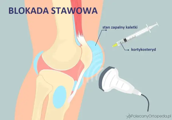Zastrzyk z kortykosteroidu w stan zapalny kaletki stawu kolanowego, widoczne ścięgna w kolanie.