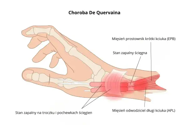 Ilustracja pokazuje zapalenie ścięgna nadgarstka w chorobie De Quervaina, z zaznaczonym stanem zapalnym na troczku i pochewkach ścięgien kciuka.